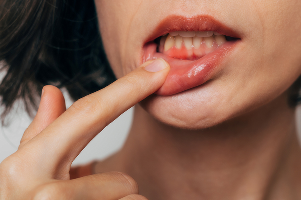 歯茎から血が出る