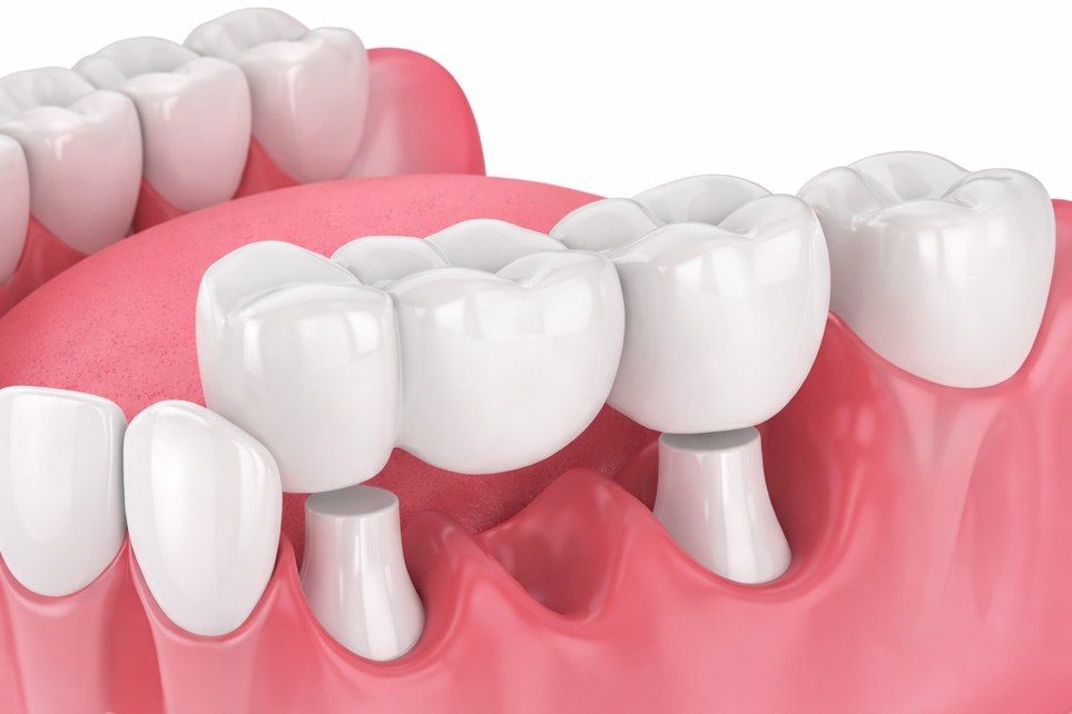 ブリッジ歯