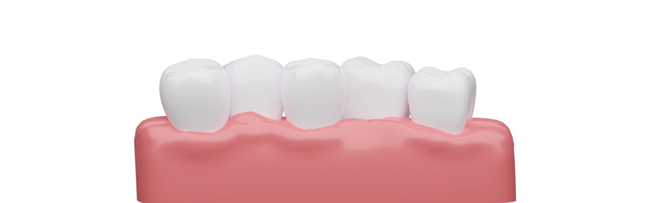 歯並びの治療
